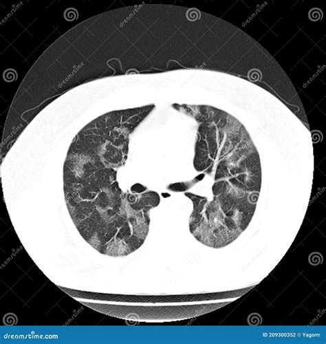 CT Scan Of The Lung With Viral Pneumonia Stock Photo | CartoonDealer.com #209300352