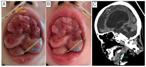 Marked Gingival Overgrowth Protruding from the Oral Cavity Due to ...