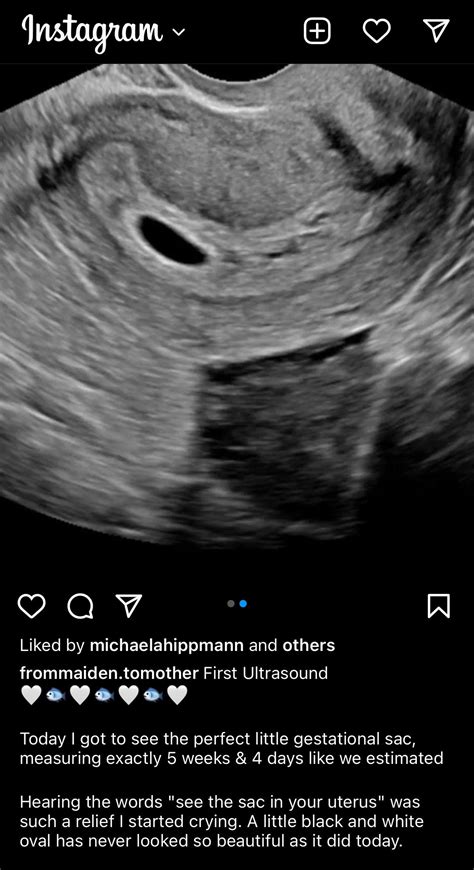 5 Week Ultrasound Pictures