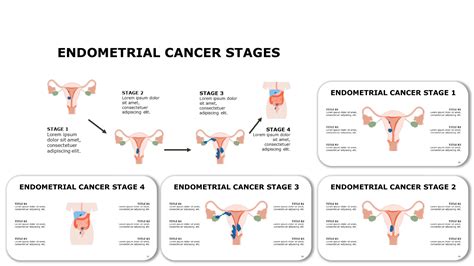 Download Endometrial Cancer PowerPoint Template| RxSlides