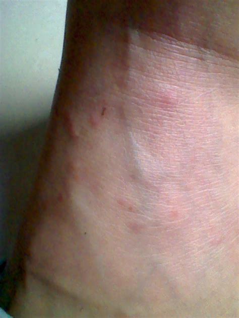 脚上皮肤长出红疹，痒，普通涂药无效，是什么皮肤病吗？怎样的药物有用？_百度知道