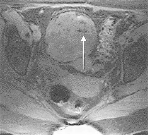 Ovarian Teratomas: Tumor Types and Imaging Characteristics | RadioGraphics