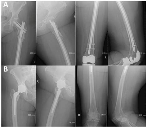 Bilateral Atypical Femoral Fracture in a Bisphosphonate-Naïve Patient ...