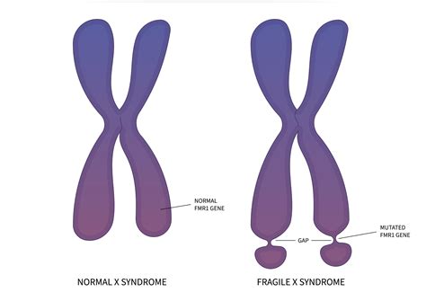 Signs Of Fragile X: What Parents Need To Know About The Symptoms