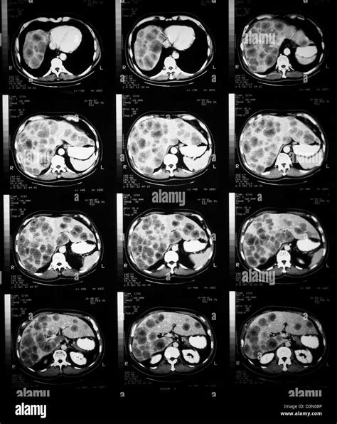 CT scan slices showing extensive metastatic liver cancer Stock Photo - Alamy