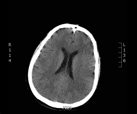 Image result for Normal Brain CT Scan Head