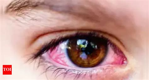Surge in conjunctivitis cases: 12 lakh school students to be screened ...