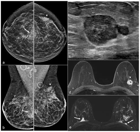 Imaging Features Following Breast Explant Surgery: A Pictorial Essay