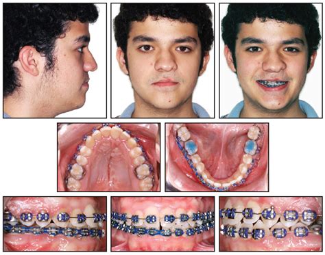 Image result for Crossbite Treatment Options