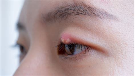 What Is a Chalazion? How to Get Rid of Eyelid Bumps - GoodRx