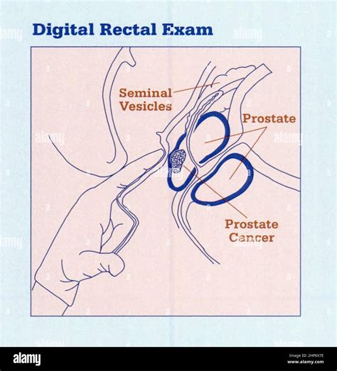 Prostate Exam Diagram