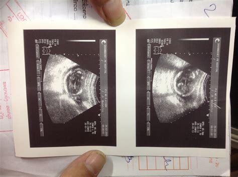 子宫内胎儿发育震撼照：10周大胎儿眼睑半闭(2)_科学探索_科技时代_新浪网