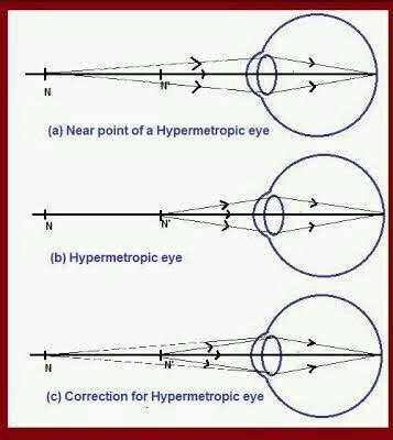 what is hypermetropia ? draw ray diagram to show the image formation of ...