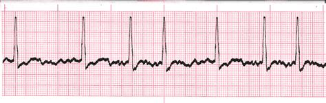Image result for Synchronized Cardioversion EKG Strips Practice