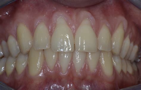 Tooth Recession 的图像结果