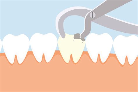 Image result for Tooth Root Extraction