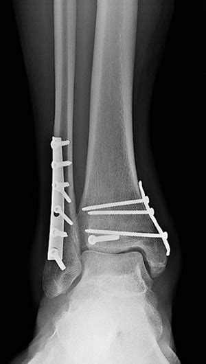 What is a bimalleolar fracture of the ankle ALQURUMRESORT.COM