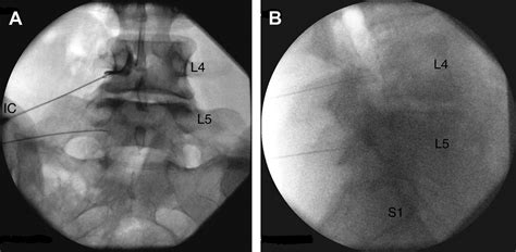 Lumbosacral Transitional Segments - Physical Medicine and ...