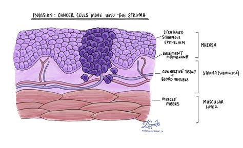 Squamous cell carcinoma of the oral cavity - MyPathologyReport.ca
