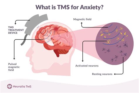Tms For Anxiety