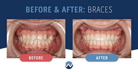 Severe Overbite Before And After Braces