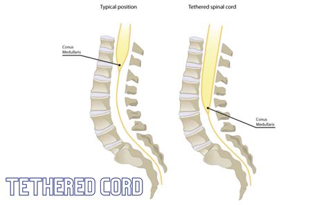 Tethered Spinal Cord Syndrome - IRAN Health Tourism Organizer - Iran Medical Tourism - IRHTO