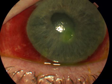 Corneal Ulcer Fluorescein Peripheral Ulcerative Keratitis: A Potential