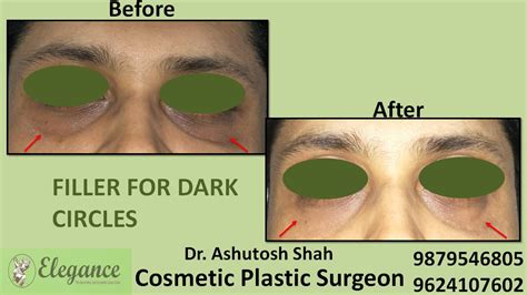 Filler For Dark Circles In Surat, Gujarat, India