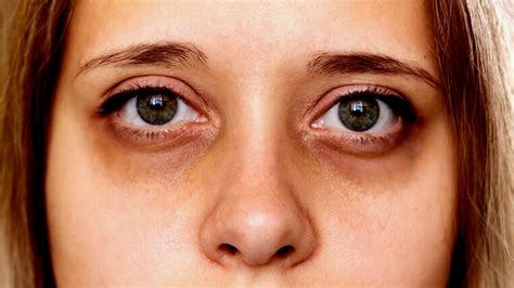 Causes Of Puffy Eyes And Home Remedies To Treat It | OnlyMyHealth