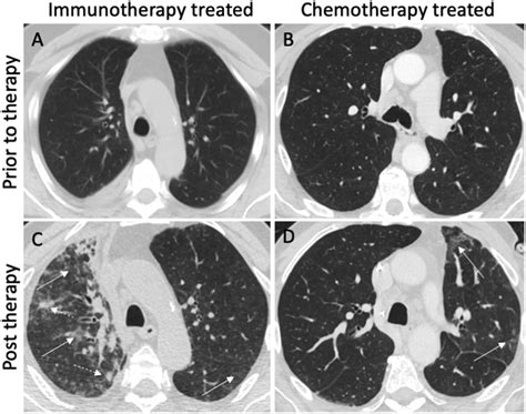 Radiographic features of pneumonitis in patients treated with immunotherapy compared to ...