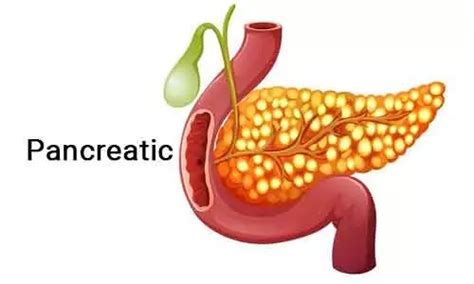 Novel way to prevent complication after pancreatic surgery, shows new study