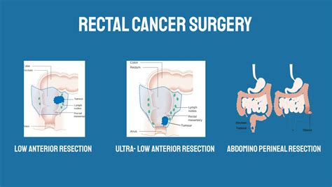 Rectal Cancer Surgery Surgery For Colon Cancer | Macmillan Cancer