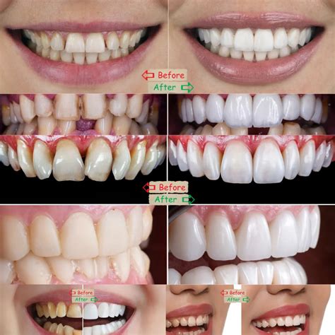 How Much Do Porcelain Veneers Cost? A Detailed Breakdown