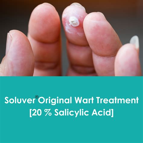 17 Salicylic Acid Wart Remover _ Salicylic Acid Warts – IMCUI
