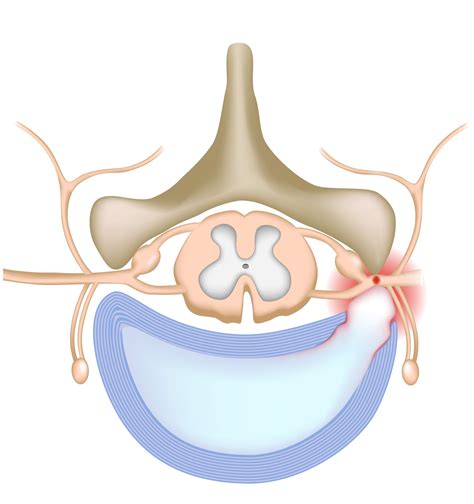 Neck Disc Osteophyte Complex at Ronald Trombly blog