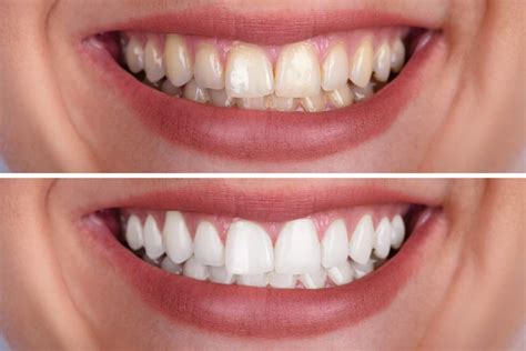 Teeth Whitening - Treatment, Services and Cost in India| Dezy