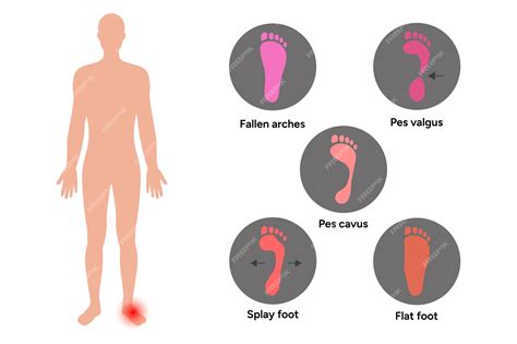 Premium Vector | Types of deformity foot fallen foot flat foot pes ...