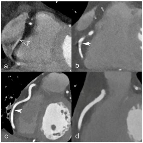 JCDD | Special Issue : Clinical Applications of Cardiovascular Computed ...