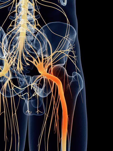 Sciatica | MedlinePlus