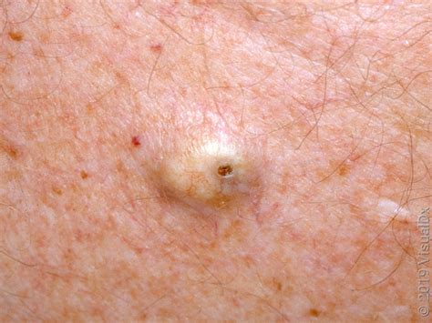 Image result for Sebaceous Cyst On Back