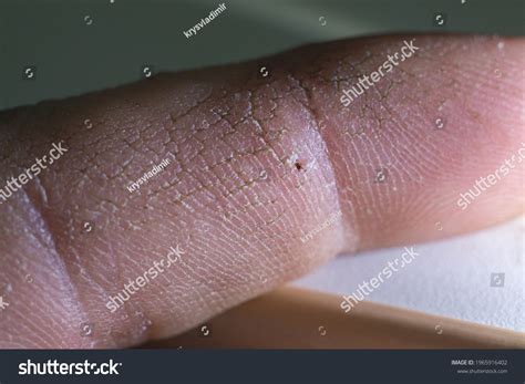 Image result for Splinter in Hand