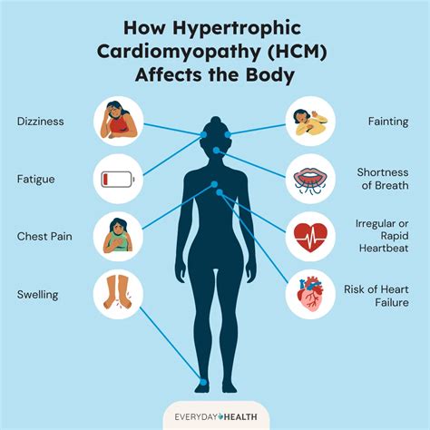 Hypertrophic Cardiomyopathy (HCM): Symptoms, Causes, Diagnosis ...