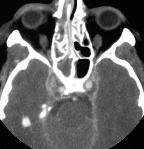 Syndromes of the orbital fissure, cavernous sinus, cerebello- pontine angle, and skull base ...