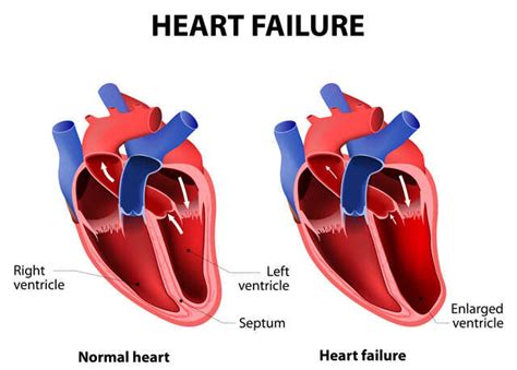 Avoid Early Onset Of Heart Failure With This Expert Guide | Femina.in