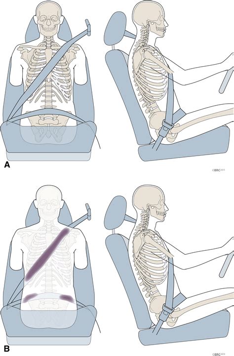 Clinical Significance of the Seat Belt Sign as Evidence of a ...