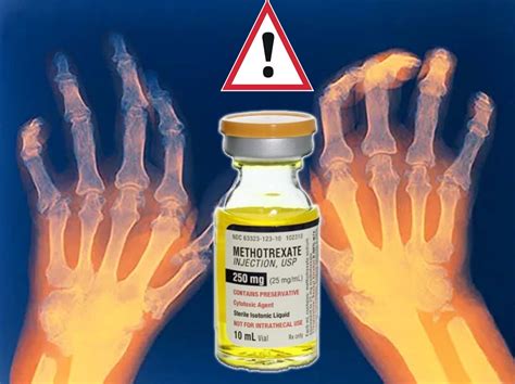 Rheumatoid arthritis drug : methotrexate may elevate a risk of a ...