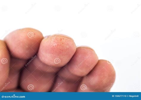 Advanced Stage of Dyshidrosis on Fingers,cracked and Peeling Skin, White Background. Skin ...