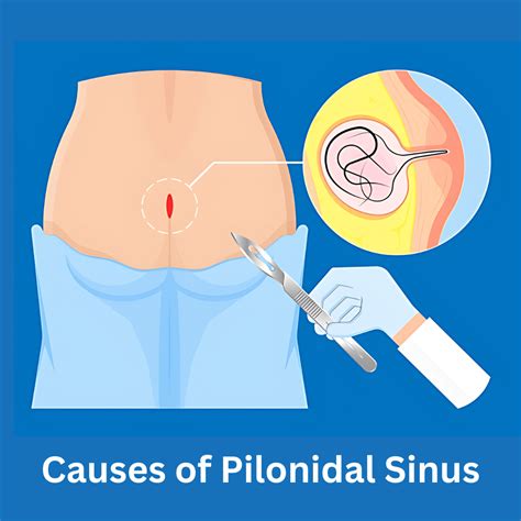 Pilonidal Sinus: Causes, Treatments, and FAQs - Dr Rajat Goel