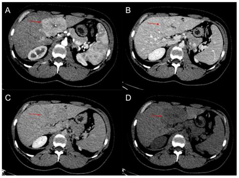 Focal Nodular Hyperplasia Central Scar