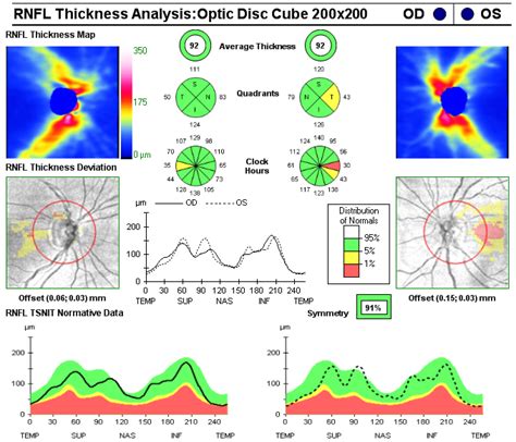 Image result for Optical Coherence Tomography Tutorial